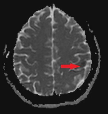 Case Report: Acute cerebral infarction caused by left atrial and right ventricular myxoma received emergency operation